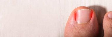 Ingrown Toenail Problem. Sore Nail And Painful Toe clipart