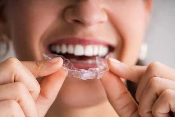 Clear Aligner Dental Night Guard Teeth — Stock Photo, Image