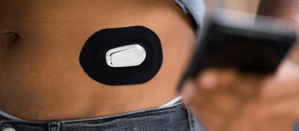 Homme Teste Niveau Glucose Avec Moniteur Glucose Continu Sur Téléphone — Photo