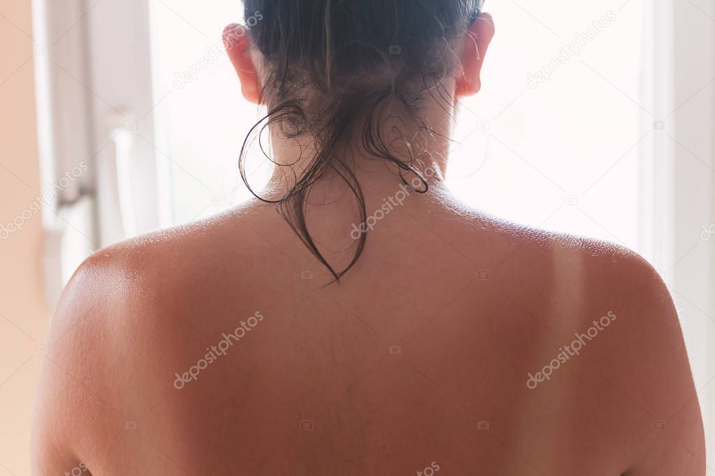 Sunburns on girl's back, unhealthy and dangerous for skin. 