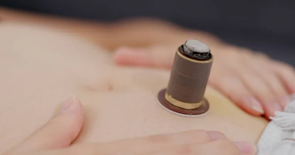 Medicina Tradicional Chinesa Moxibustion Terapia — Fotografia de Stock