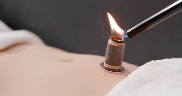 Chinese Medicine Moxibustion Therapy — Stock Photo, Image