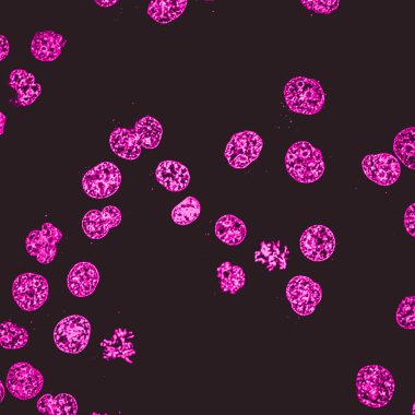 İnsan akut lösemi hücre kültürünü K562 confocal mikroskobu. Canlı hücreleri DNA molekülleri (mor renk) ile lekeli.
