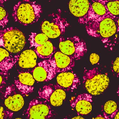 İnsan akut lösemi hücre kültürünü confocal mikroskobu