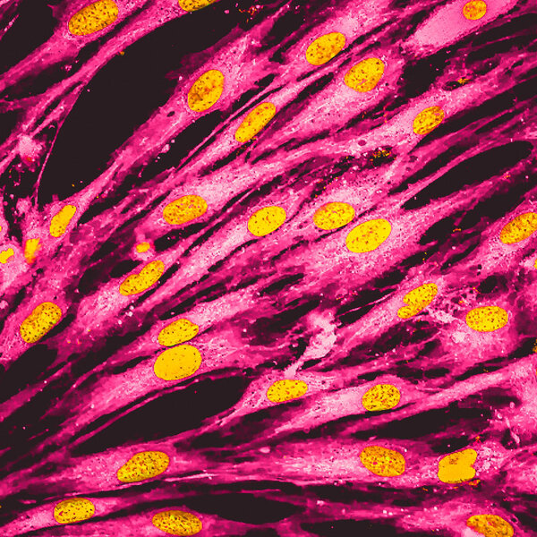 Real fluorescence microscopic view of human skin cells in culture. Nucleus are in yellow, cell membranes were labeled with pink