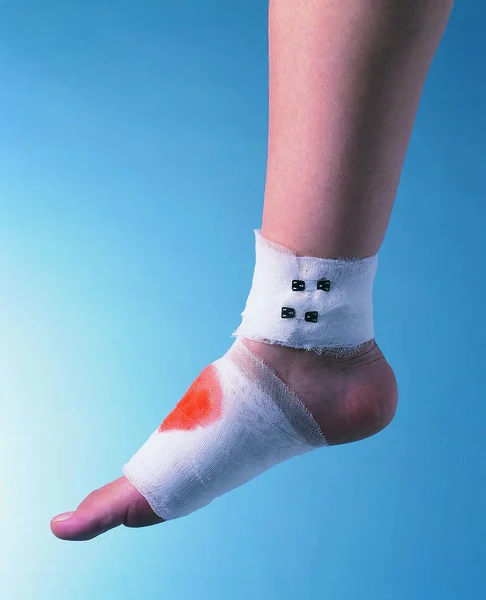 Zbliżenie Ludzkiej Nogi Bandaż — Zdjęcie stockowe
