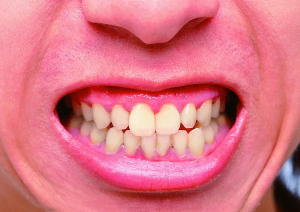 Dişleri Olan Bir Erkeğin Ağzını Kapat — Stok fotoğraf