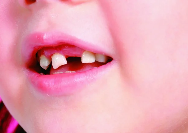 Kırık Dişleri Olan Sevimli Çocuğa Yakın Dur — Stok fotoğraf
