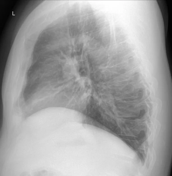 Рентгенівське сканування легень чоловічого курця без редагування. Вид збоку з, ймовірно, патологічним збудженням — стокове фото