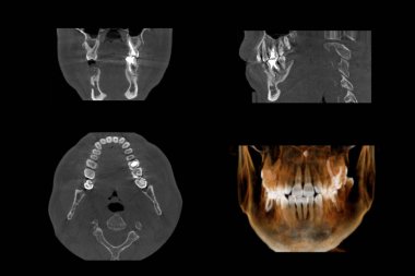 Beyaz arka planda birden fazla sorun ile insan erkek kürek diş parçası Mri tarayıcı dilimleri seti.