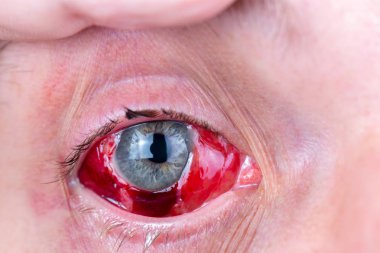 selektif odak ile postoperatif ağır iltihaplı göz closeup çekim