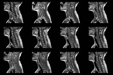 C6-C7 segmentinin çift taraflı paramedial ekstrüzyonu olan beyaz erkek boyun bölgesinin radyal MRI taramaları.