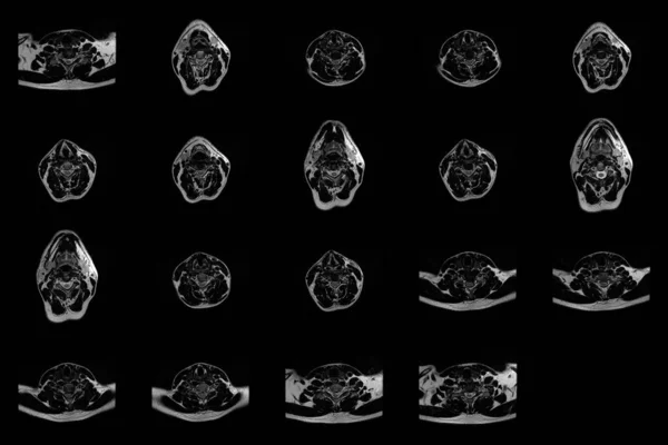 Набір поперечних МРТ сканувань ділянки шиї кавказького чоловіка з двостороннім параметричним видавлюванням сегмента С6-С7 з радикулопатією — стокове фото