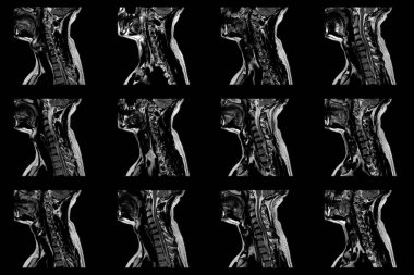 C6-C7 segmentinin çift taraflı paramedial ekstrüzyonu olan beyaz erkek boyun bölgesinin radyal MRI taramaları.