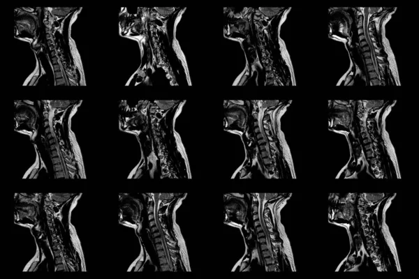 Conjunto de exames de RM sagital de região cervical de homem caucasiano com extrusão paramediana bilateral do segmento C6-C7 com radiculopatia — Fotografia de Stock