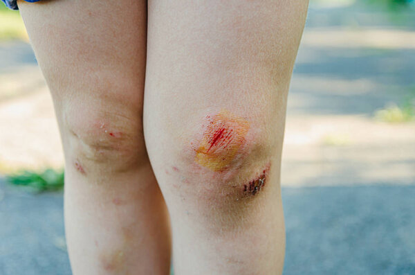 child ran, fell and cut his knees. A little boy on a summer vaca