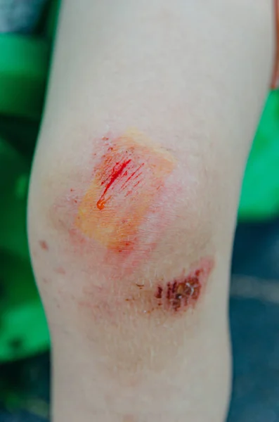 child ran, fell and cut his knees. A little boy on a summer vaca