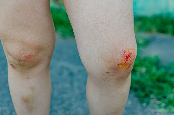 child ran, fell and cut his knees. A little boy on a summer vaca