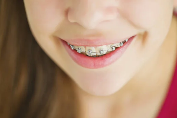 Close-up portret van glimlachende tiener meisje tonen tandheelkundige braces.Isolated op witte achtergrond. — Stockfoto