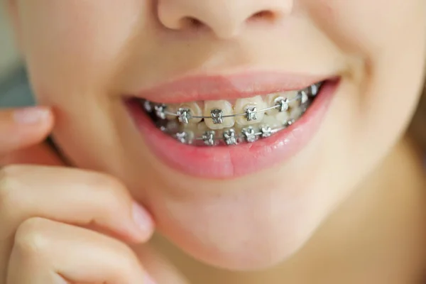 Close up retrato de menina adolescente sorridente mostrando órteses dentárias.Isolado no fundo branco. — Fotografia de Stock