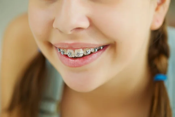 Close up portrait of smiling teenager girl showing dental braces.Isolated on white background. — Stock Photo, Image