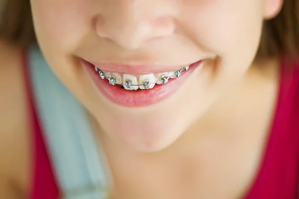 Close up retrato de menina adolescente sorridente mostrando órteses dentárias.Isolado no fundo branco. — Fotografia de Stock