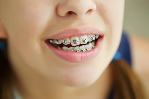 Close up retrato de menina adolescente sorridente mostrando órteses dentárias.Isolado no fundo branco. — Fotografia de Stock