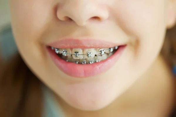 Close up retrato de menina adolescente sorridente mostrando órteses dentárias.Isolado no fundo branco. — Fotografia de Stock