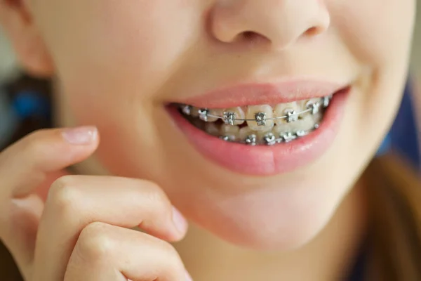 Närbild porträtt av leende tonåring flicka som visar tandställning. Isolerad på vit bakgrund. — Stockfoto