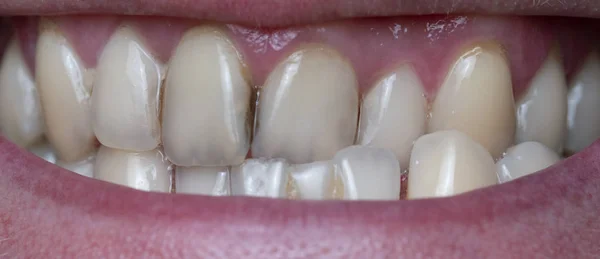 コーヒーの残留によって引き起こされる人間の歯の歯垢の閉鎖 — ストック写真