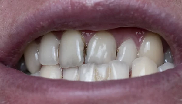 Крупный План Зубной Бляшки Зубах Человека Вызванный Остатками Кофе — стоковое фото
