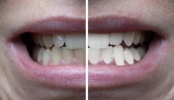 美白前和后妇女的牙齿特写镜头 — 图库照片