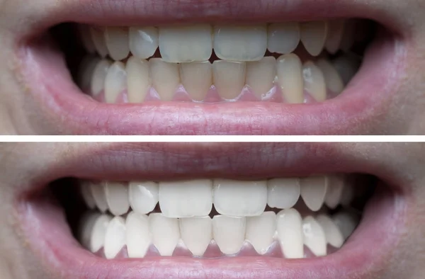 Closeup Των Δοντιών Της Γυναίκας Πριν Από Και Μετά Λεύκανση — Φωτογραφία Αρχείου