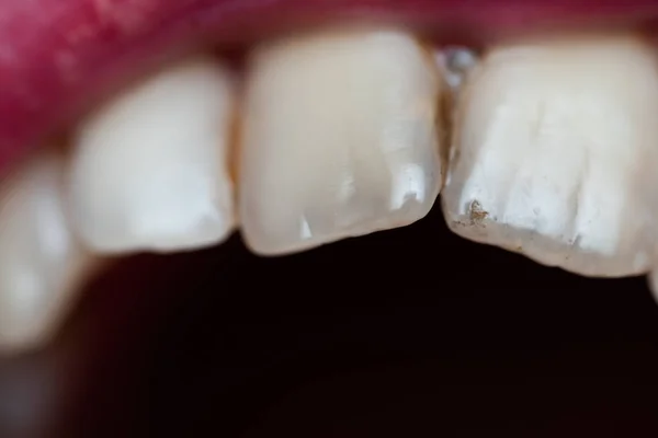 コーヒーの残留によって引き起こされる人間の歯の歯垢の閉鎖 — ストック写真