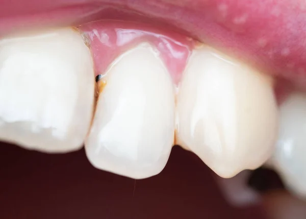 Closeup of dental plaque on man\'s teeth caused by coffee residual