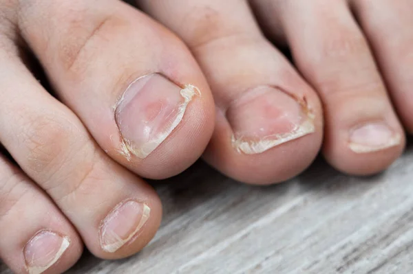 Ugly Toes Girl Fungus Ingrown Toenails Dry Skin Her Feet — Stock Photo, Image