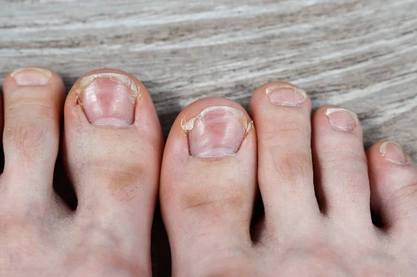 Vieze Tenen Met Haar Ingegroeide Gebarsten Nagels Likdoorns Droge Huid — Stockfoto