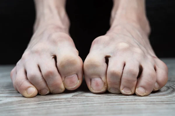 Страшные Тонкие Ноги Больными Заправленными Пальцами Сужения Вросшими Ногтями Медицинский — стоковое фото