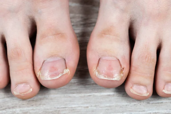 Close Big Toes Ugly Broken Nails Calluses Ingrown Toenail Discomfort — Stock Photo, Image