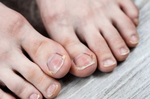 Ugly Toes Girl Fungus Ingrown Toenails Poor Hygiene Urgent Need — Stock Photo, Image