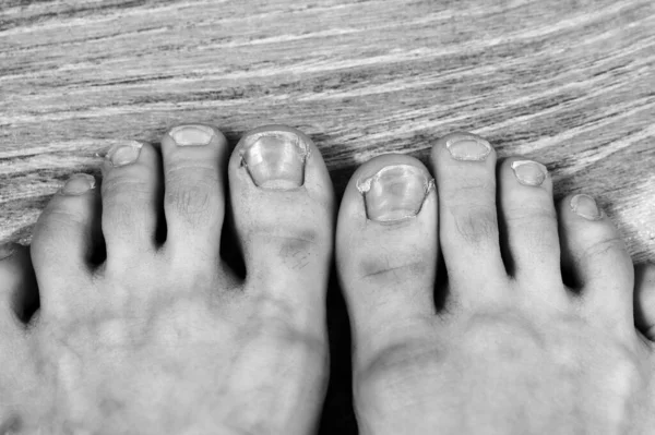 Black White Photo Broken Ingrown Ugly Toenails Sloppy Girl Overgrown — Stock Photo, Image