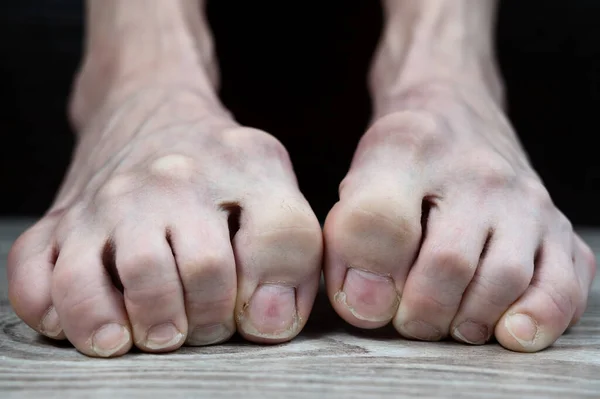 Страшно Грязные Тонкие Ноги Болью Заправленные Пальцы Ограничений Вросших Ногтей — стоковое фото
