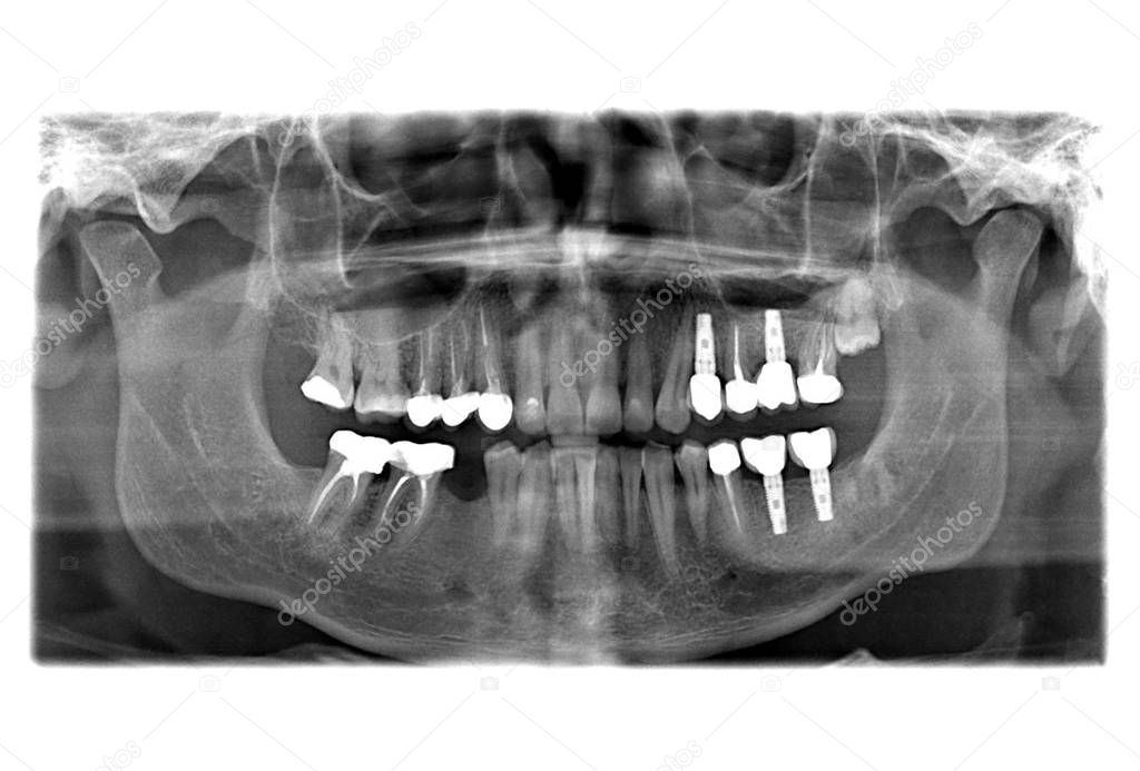 X ray of teeth