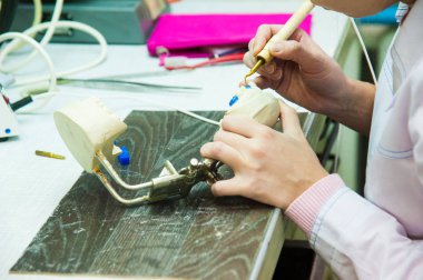 Alçı döküm yapılmış bir implant diş protez diş hekimi yapar