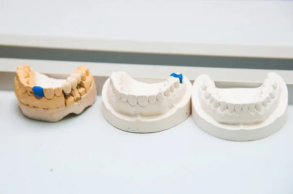 El dentista hace una prótesis de implante dental hecha de yeso — Foto de Stock
