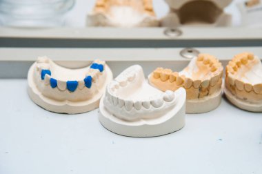 Alçı döküm yapılmış bir implant diş protez diş hekimi yapar