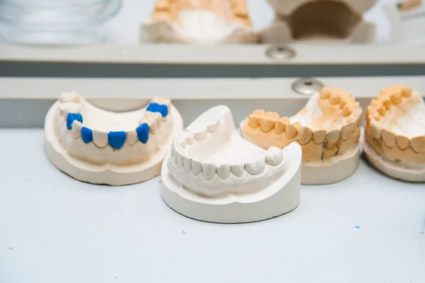 Dentist makes a dental implant prosthesis made of plaster cast