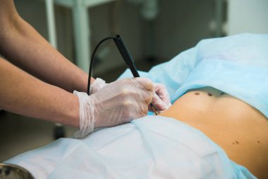 Papillomların çıkarılması, lazer aletli benler. 