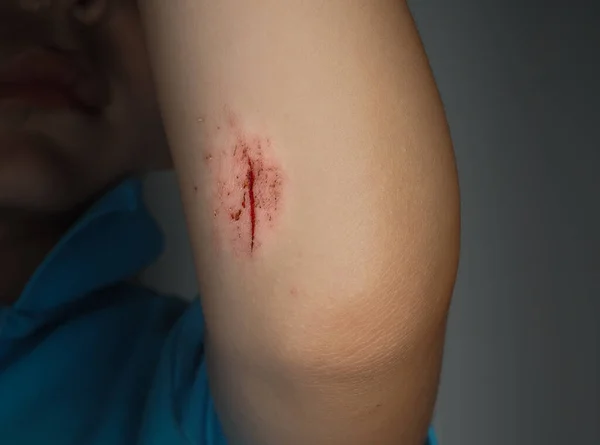 Young Boy Fresh Bruise Arm Showing Part Face Low Key — Stock Photo, Image