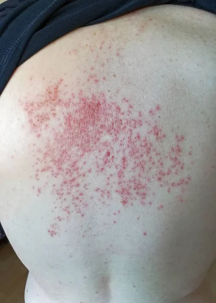 裏面にアレルギー反応 — ストック写真